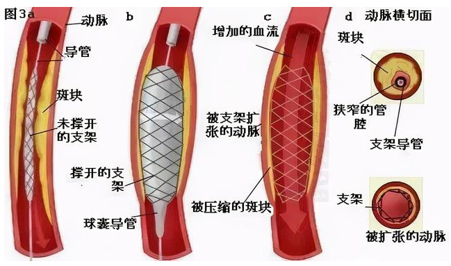 心脏支架20倍的暴利，被国家给灭了