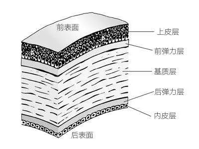 第一批做近视手术的人，现在后悔了吗？